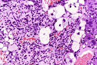 hemangiosarcoma