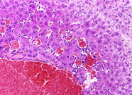 hemangiosarcoma