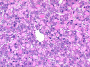 hyaline bodies