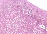 large areas of fatty change liver