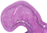 large areas of fatty change liver