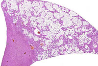 Ito cell tumor