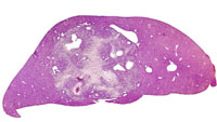 Ito cell tumor