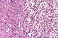 Ito cell tumor