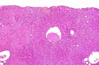 large areas of fatty change liver