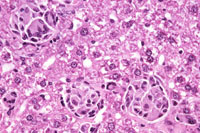 large areas of fatty change liver