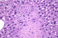 large areas of fatty change liver