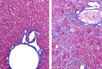 Bile duct cyst