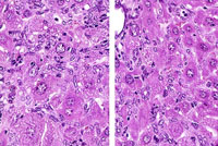 Bile duct cyst