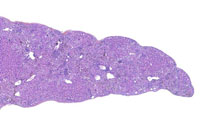 fatty change in liver