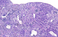 fatty change in liver