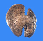 fatty change in liver