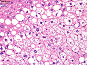 fatty change in liver