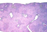 large areas of fatty change liver