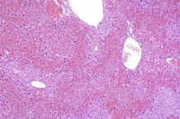 large areas of fatty change liver