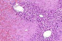 large areas of fatty change liver