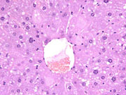 large areas of fatty change liver