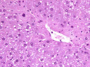 large areas of fatty change liver