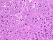 large areas of fatty change liver