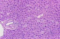 kupffer cell hyperplasia