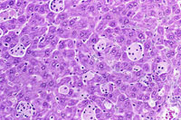 kupffer cell hyperplasia