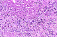 malignant lymphocytes