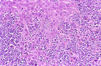 malignant lymphocytes