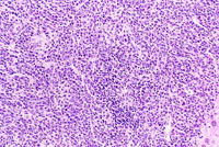 malignant lymphocytes