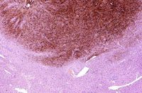 malignant melanoma