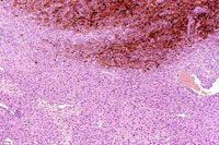 malignant melanoma