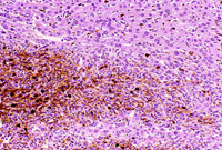 malignant melanoma