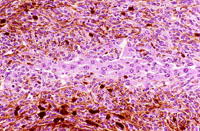 malignant melanoma