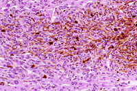 malignant melanoma