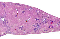 Myelodysplasia