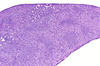 Myeloproliferative infiltration