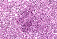 large areas of fatty change liver