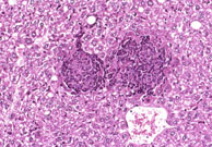 large areas of fatty change liver