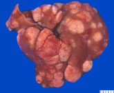 Hepatocellular Carcinoma