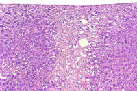 fatty change in liver