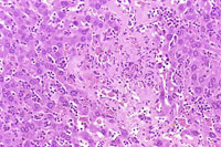 fatty change in liver