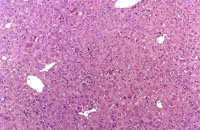 oval cell hyperplasia