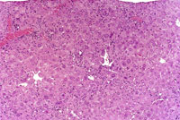 oval cell hyperplasia