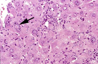 oval cell hyperplasia