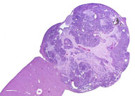 ovarian teratoma