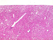 fatty change in liver