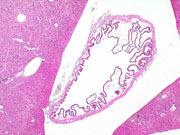 Submucosal edema