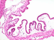 Submucosal edema