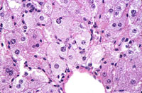 fatty change in liver