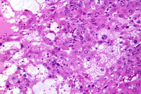 fatty change in liver