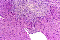 sarcoma